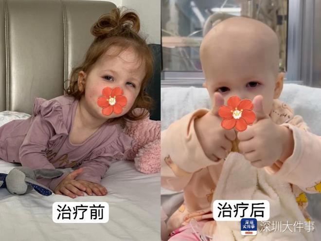 基因治療“逆天改命”！瑞典罕見遺傳病患兒萬里赴粵重獲新生(圖2)